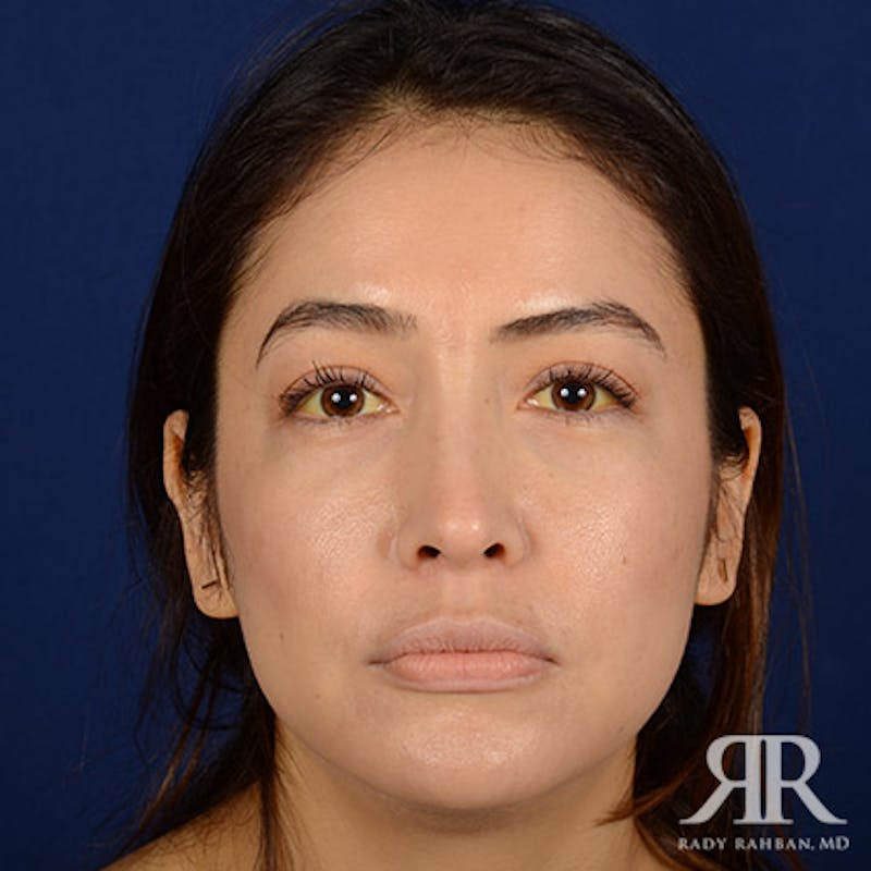 Female Rhinoplasty Before & After Gallery - Patient 176852 - Image 2