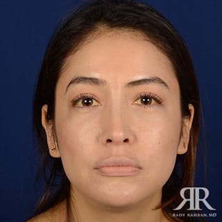 Female Rhinoplasty Before & After Gallery - Patient 176852 - Image 2