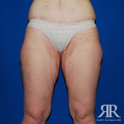 Thigh Lift Before & After Gallery - Patient 413607 - Image 1
