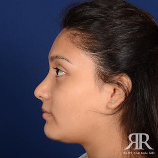 Chin Augmentation Before & After Gallery - Patient 268398 - Image 6