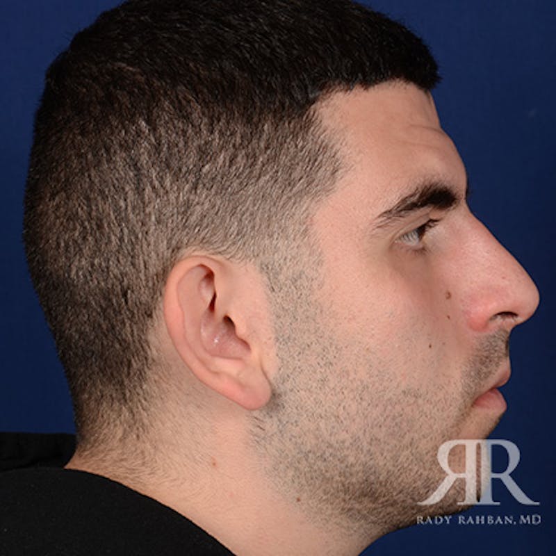 Ear Pinning Surgery Before & After Gallery - Patient 860857 - Image 5