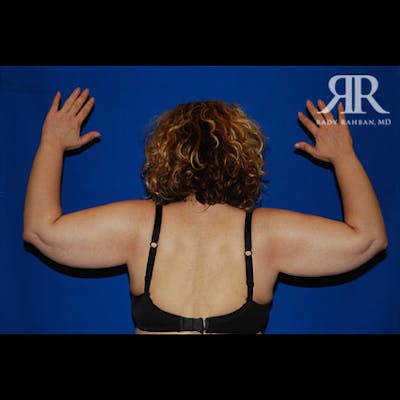Arm Lift Before & After Gallery - Patient 282849 - Image 1