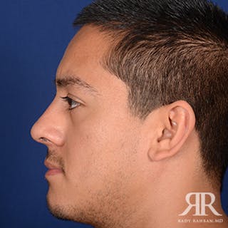 Ethnic Rhinoplasty Before & After Gallery - Patient 207111 - Image 6