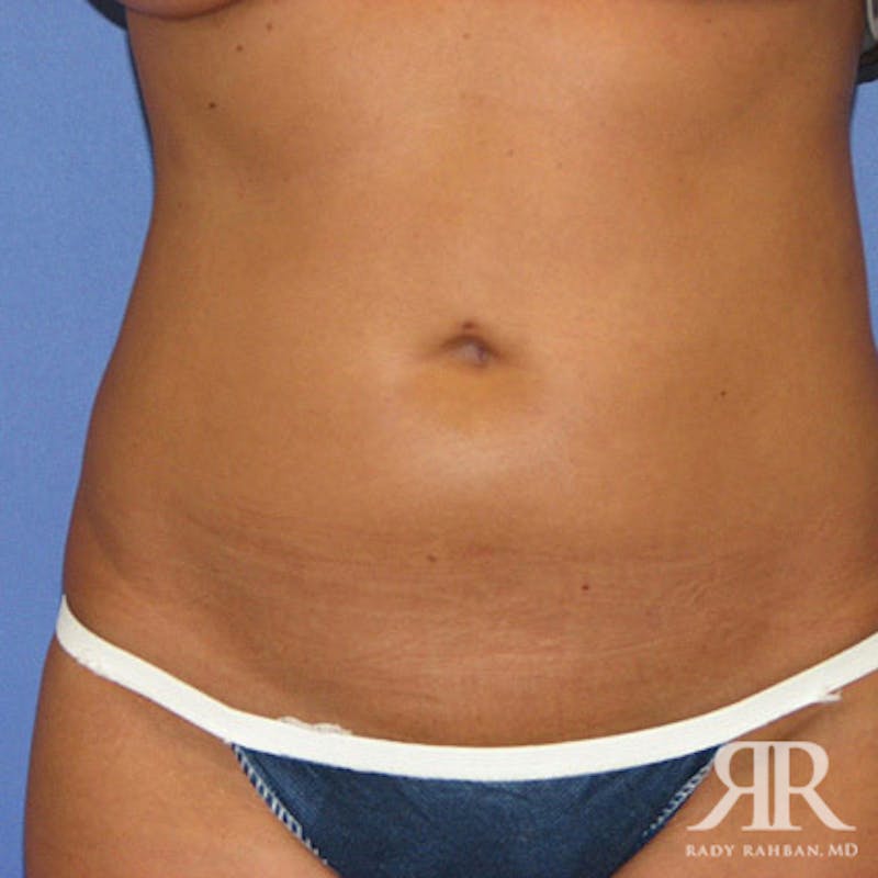 Before and after patient results