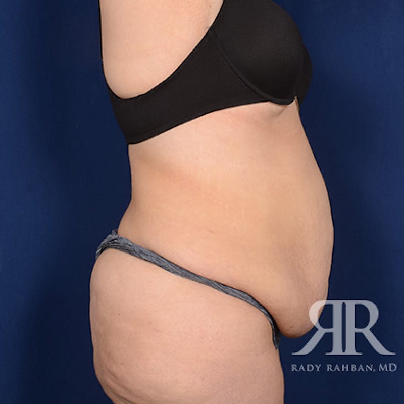 Body Lift Before & After Gallery - Patient 295631 - Image 5