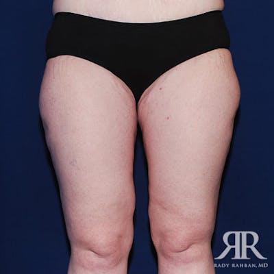 Thigh Lift Before & After Gallery - Patient 413607 - Image 2