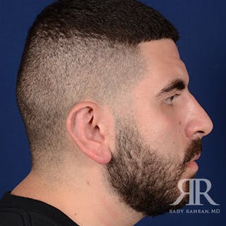 Ear Pinning Surgery Before & After Gallery - Patient 860857 - Image 6