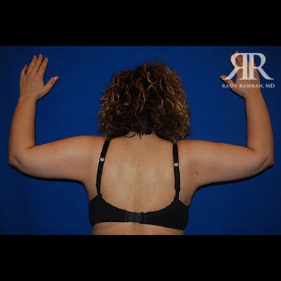 Arm Lift Before & After Gallery - Patient 282849 - Image 2