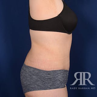 Body Lift Before & After Gallery - Patient 295631 - Image 6