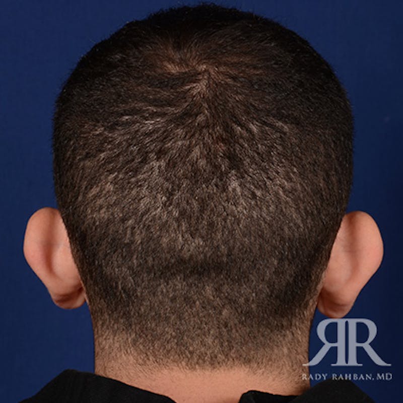 Ear Pinning Surgery Before & After Gallery - Patient 860857 - Image 7
