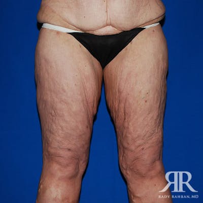 Thigh Lift Before & After Gallery - Patient 421682 - Image 1