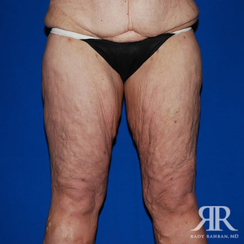 Thigh Lift Before & After Gallery - Patient 421682 - Image 1