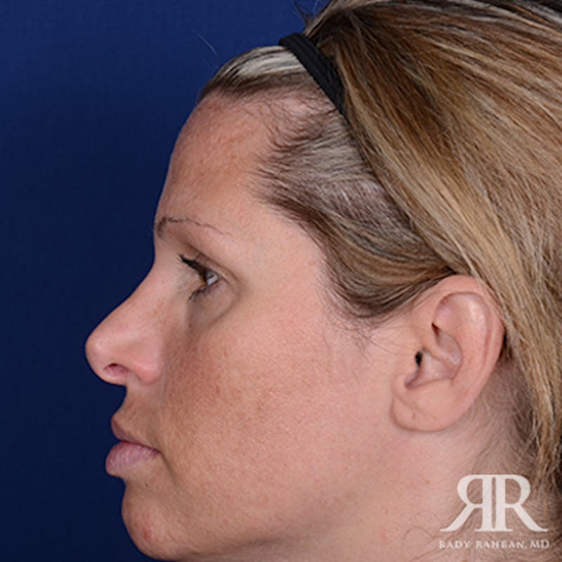 Corrective / Revision Rhinoplasty Before & After Gallery - Patient 367292 - Image 5
