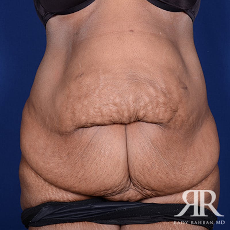 Body Lift Before & After Gallery - Patient 402969 - Image 1