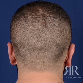 Ear Pinning Surgery Before & After Gallery - Patient 860857 - Image 8