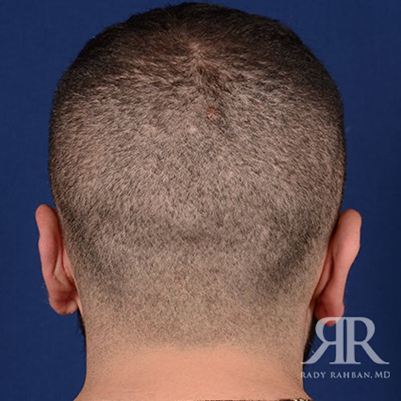 Ear Pinning Surgery Before & After Gallery - Patient 860857 - Image 8