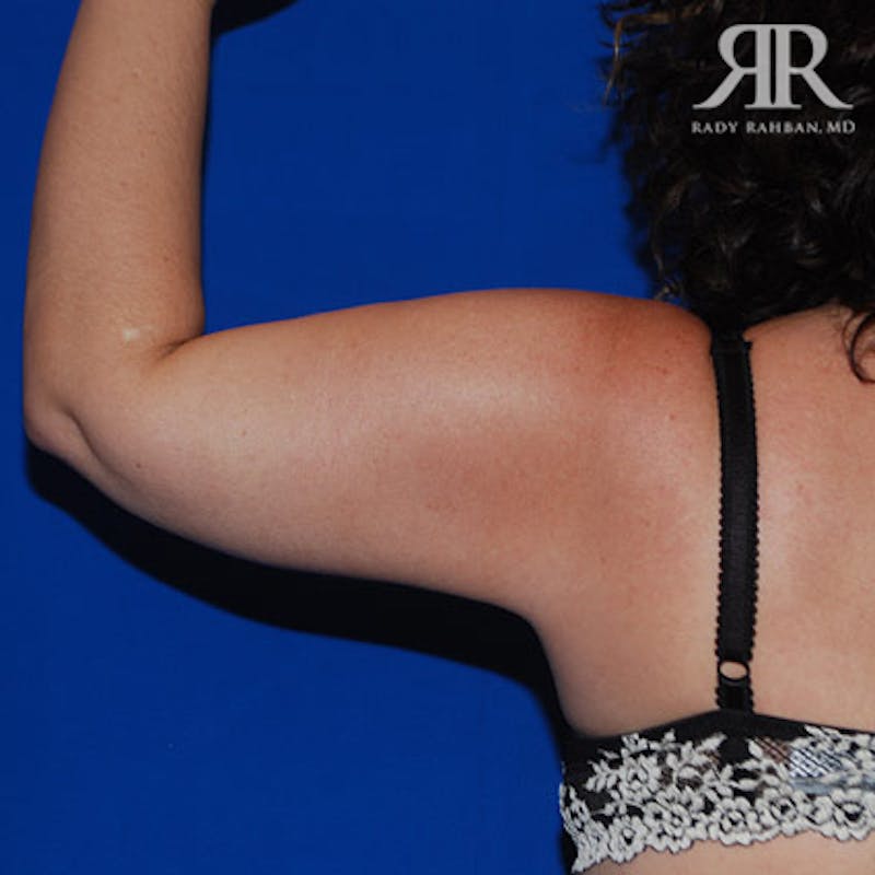 Arm Lift Before & After Gallery - Patient 282849 - Image 4
