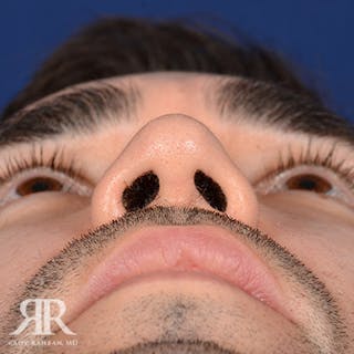 Rhinoplasty w/ Chin Implant Before & After Gallery - Patient 857428 - Image 8