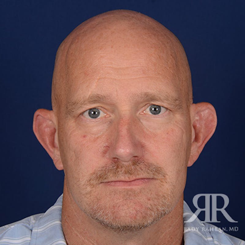 Ear Pinning Surgery Before & After Gallery - Patient 409602 - Image 1