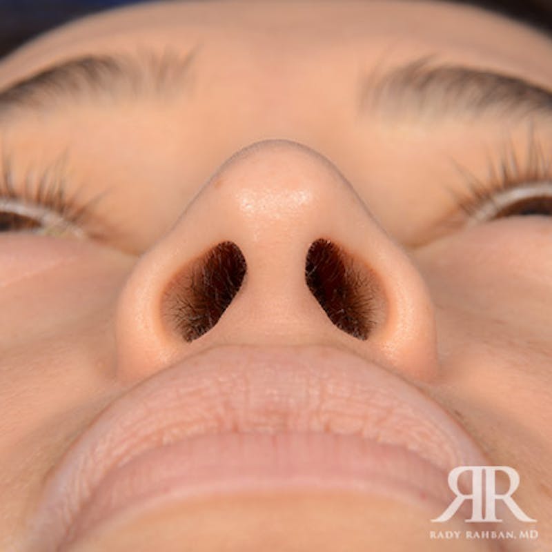 Female Rhinoplasty Before & After Gallery - Patient 176852 - Image 7