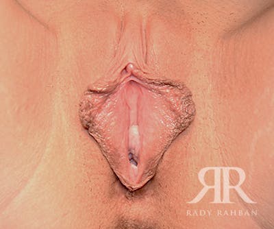Labiaplasty Before & After Gallery - Patient 112946 - Image 1