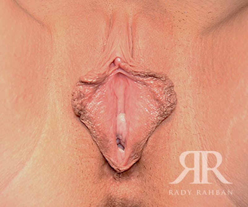 Labiaplasty Before & After Gallery - Patient 112946 - Image 1