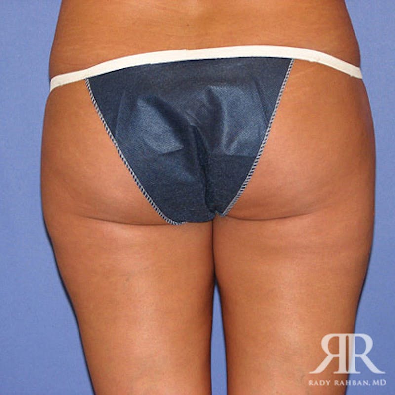 Liposuction Before & After Gallery - Patient 169261 - Image 6