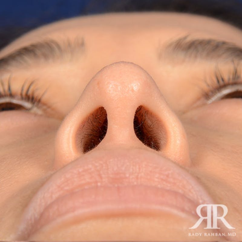 Female Rhinoplasty Before & After Gallery - Patient 176852 - Image 8