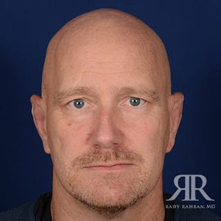 Ear Pinning Surgery Before & After Gallery - Patient 409602 - Image 2