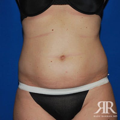 Liposuction Before & After Gallery - Patient 155070 - Image 1