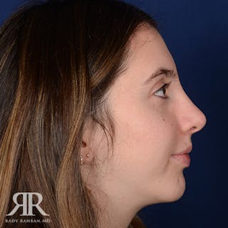 Chin Augmentation Before & After Gallery - Patient 191179 - Image 6