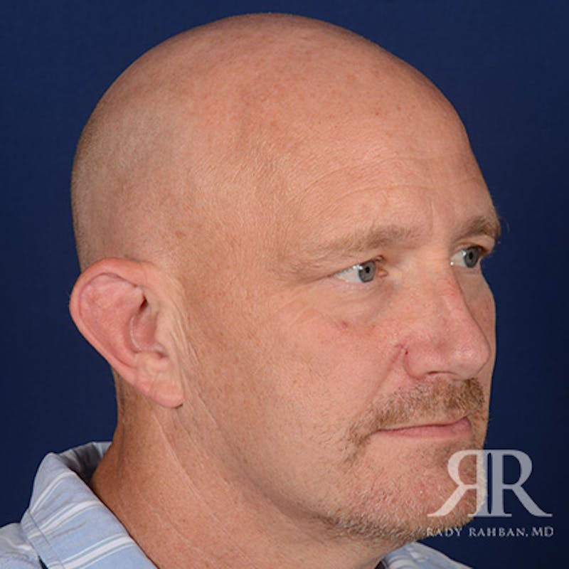 Ear Pinning Surgery Before & After Gallery - Patient 409602 - Image 3