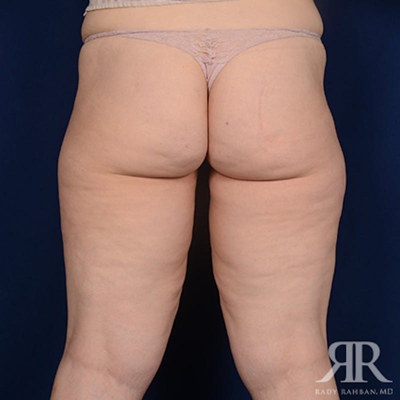 Thigh Lift Before & After Gallery - Patient 218735 - Image 3
