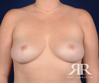 Breast Reduction Before & After Gallery - Patient 264070 - Image 2
