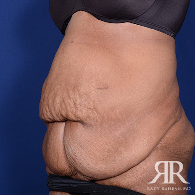 Body Lift Before & After Gallery - Patient 402969 - Image 3