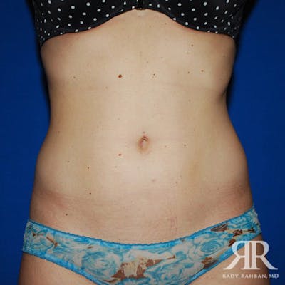 Liposuction Before & After Gallery - Patient 155070 - Image 2