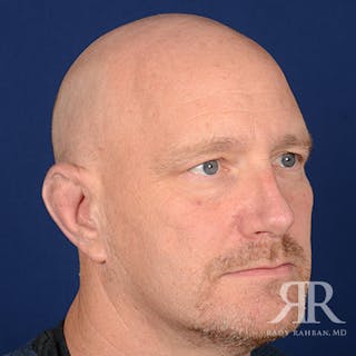 Ear Pinning Surgery Before & After Gallery - Patient 409602 - Image 4