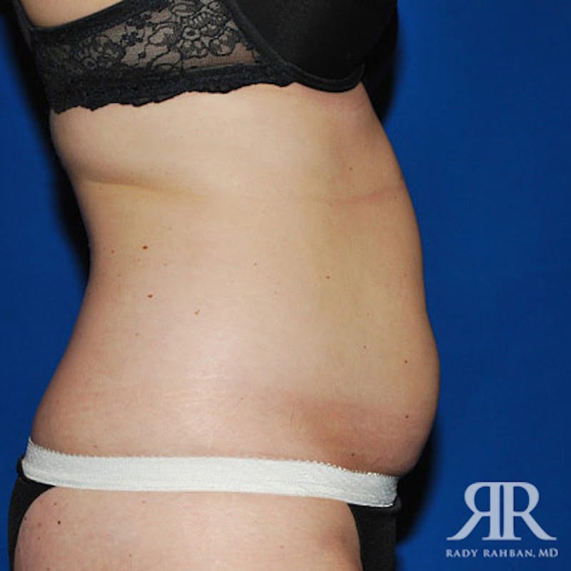 Liposuction Before & After Gallery - Patient 155070 - Image 3