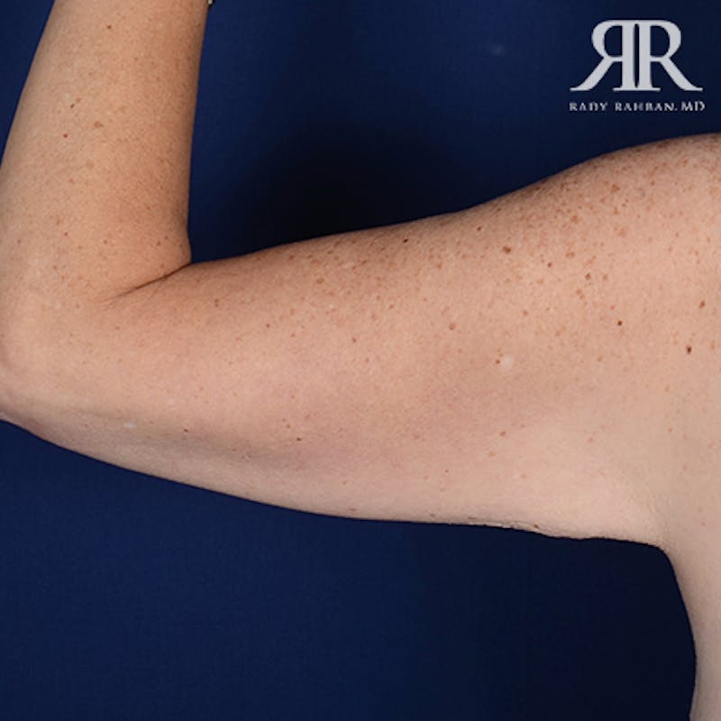 Arm Lift Before & After Gallery - Patient 377101 - Image 3