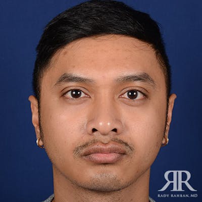 Chin Augmentation Before & After Gallery - Patient 323041 - Image 2