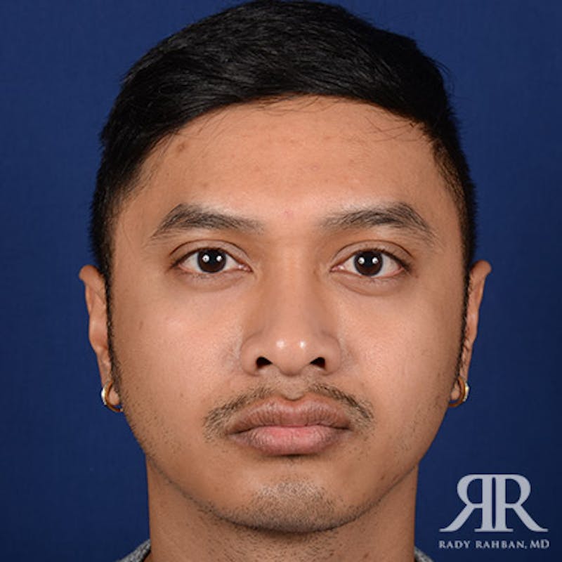 Chin Augmentation Before & After Gallery - Patient 323041 - Image 2