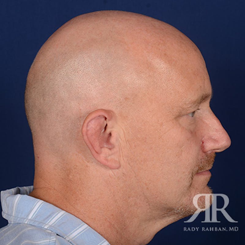 Ear Pinning Surgery Before & After Gallery - Patient 409602 - Image 5