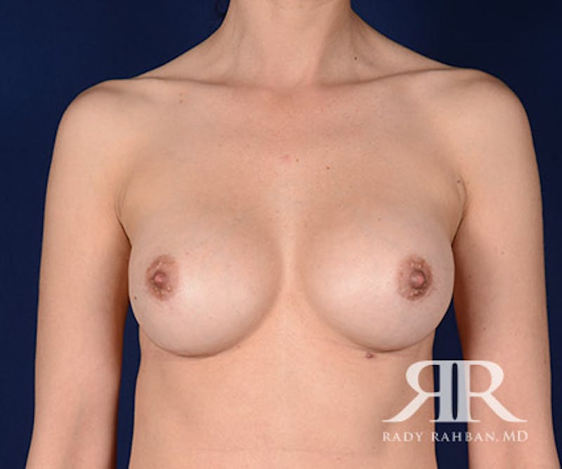 Corrective Breast Surgery Before & After Gallery - Patient 422553 - Image 2