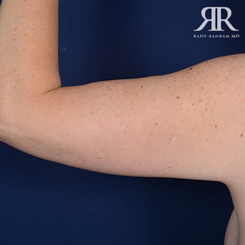 Arm Lift Before & After Gallery - Patient 377101 - Image 4