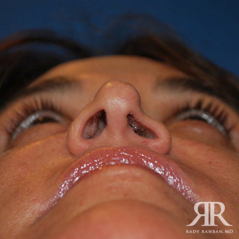 Corrective / Revision Rhinoplasty Before & After Gallery - Patient 242372 - Image 3