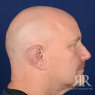 Ear Pinning Surgery Before & After Gallery - Patient 409602 - Image 6