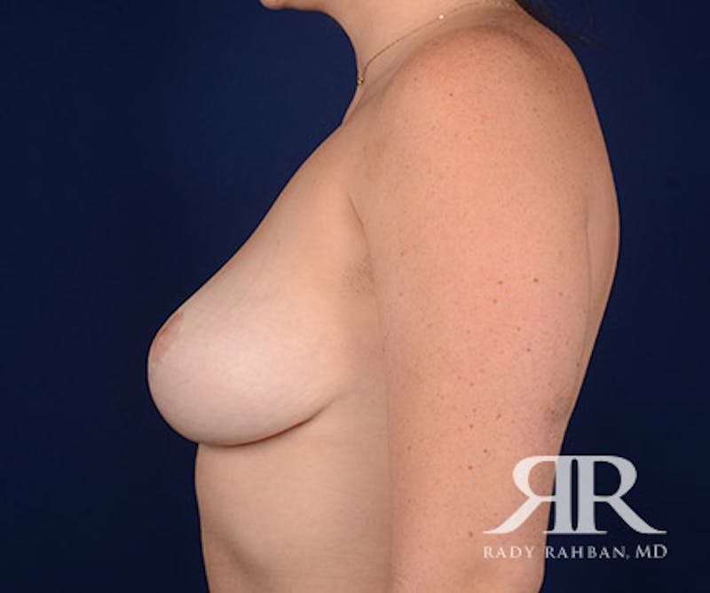Breast Reduction Before & After Gallery - Patient 264070 - Image 6