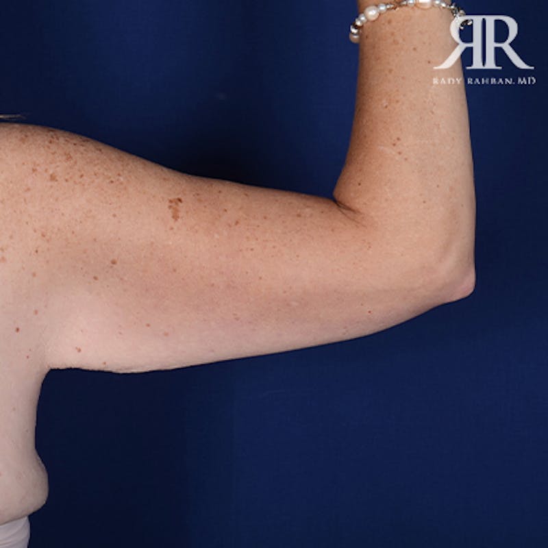 Arm Lift Before & After Gallery - Patient 377101 - Image 5