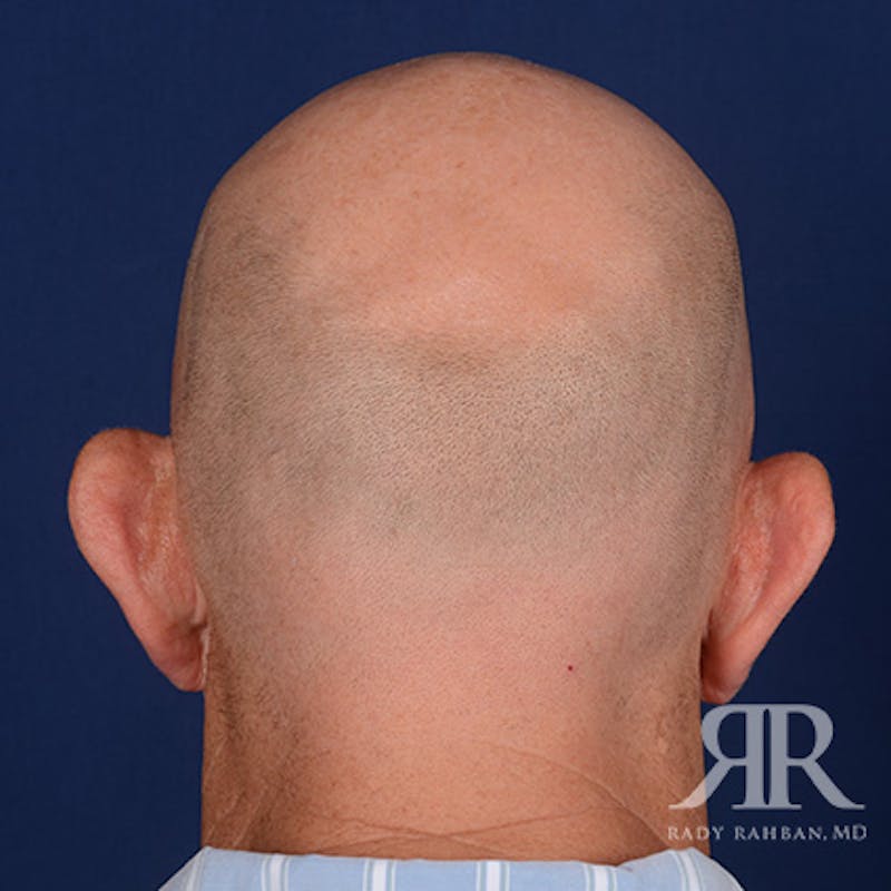 Ear Pinning Surgery Before & After Gallery - Patient 409602 - Image 7