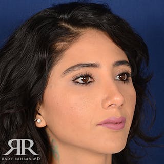 Female Rhinoplasty Before & After Gallery - Patient 133897 - Image 4